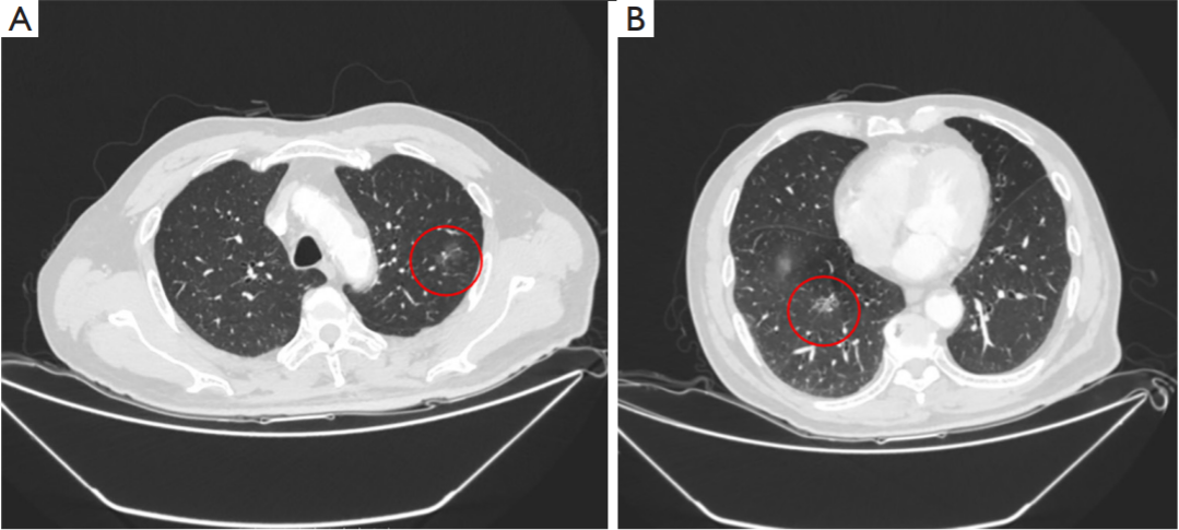 Translational Lung Cancer Research_4